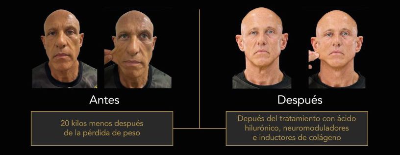 La otra cara del éxito de los GLP-1: el nuevo reto de la medicina estética