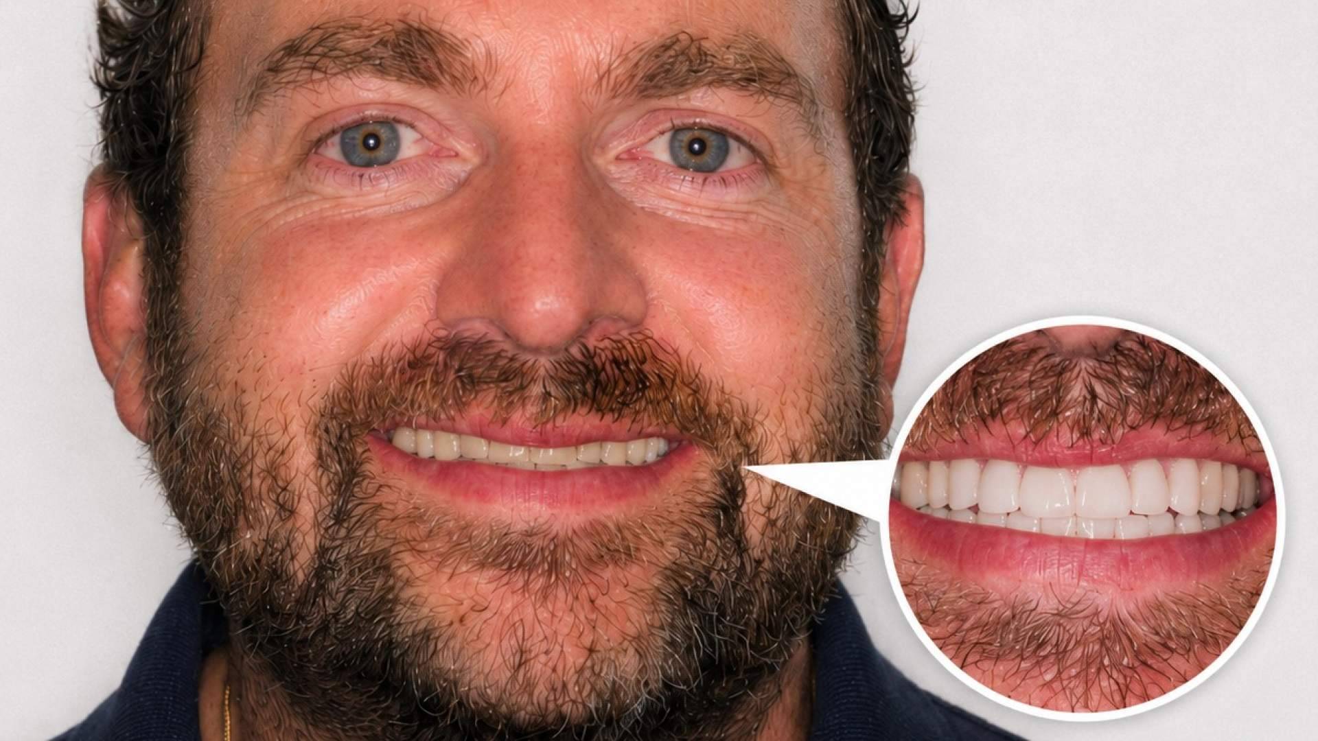 Cómo las carillas dentales de la Clínica Calvo de Mora permiten corregir la sonrisa sin alterar la funcionalidad